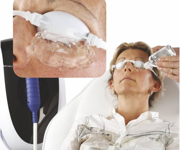 IPL-Behandlung mit dem E-Eye-Gerät