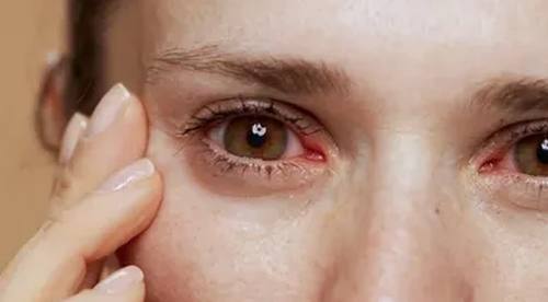 Gerötetes Auge einer Patientin