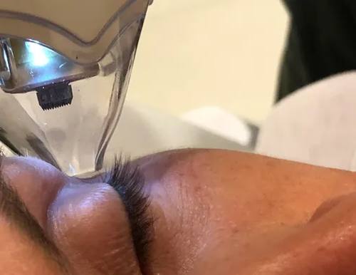 Tixel-Behandlung am Augenlid